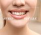 Teeth whitening Hudsonville MI cosmetic dentists